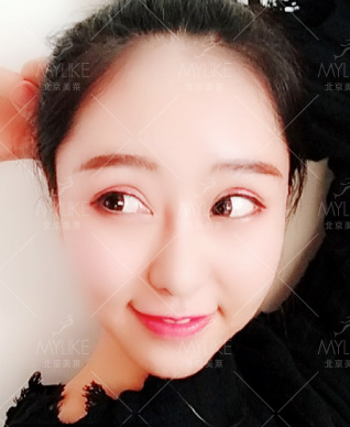 美萊案例呂思佳對比圖后