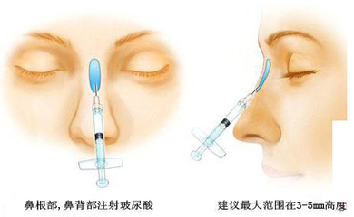 廣州哪個機(jī)構(gòu)隆鼻比較好呢