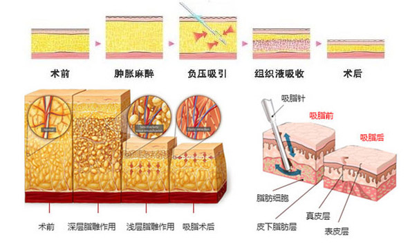 廣州美萊吸脂減肥術(shù)后效果行不行呢