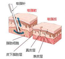 抽脂減肥會不會有后遺癥