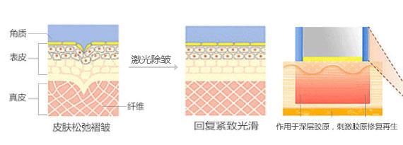 西安面部除皺失敗了怎么修復