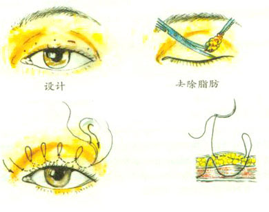 上海做雙眼皮整形能保持多久