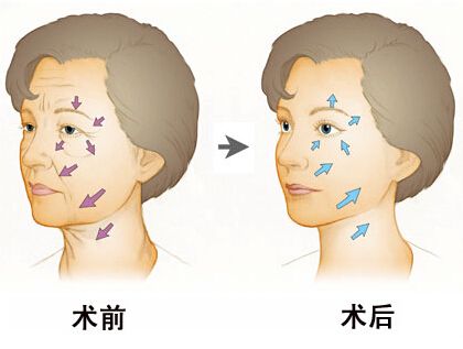 泉州做電波拉皮能維持多長(zhǎng)時(shí)間