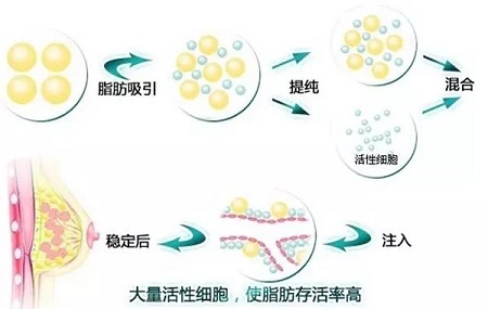 自體豐胸手術(shù)價(jià)格