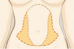 上海做腹部吸脂術(shù)后要注意哪些呢