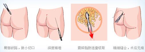 吸脂瘦臀