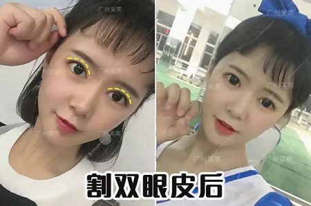 雙眼皮怎樣割