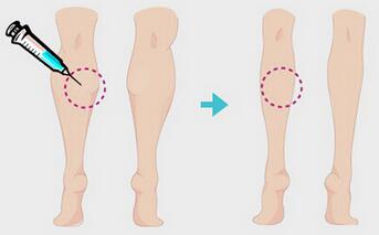 一針瘦腿多少錢？