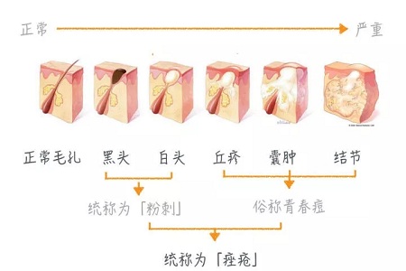 擠痘竟然被送進ICU！你的痘痘還好嗎？