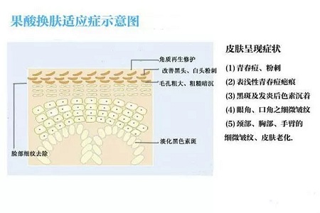 擠痘竟然被送進ICU！你的痘痘還好嗎？