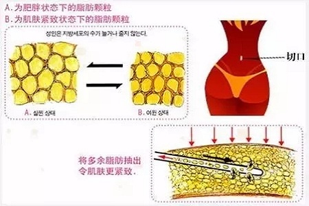 吸脂，怎樣做才算是剛剛好？