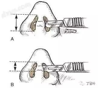 隆鼻手術(shù)切口在哪里？才能自然不留疤