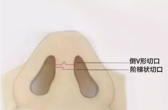 隆鼻手術(shù)切口在哪里？才能自然不留疤