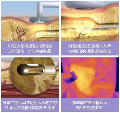 Bodytite黃金微雕：比吸脂更好的瘦身利器