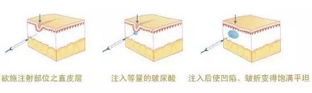 法令紋、川字紋