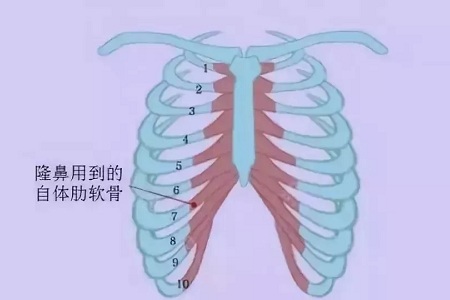 什么，隆鼻方式竟然有這么多種？