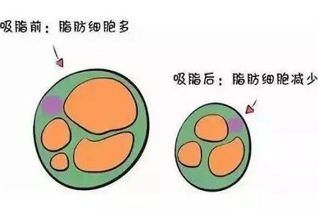 關(guān)于吸脂那些不能說的秘密，今天要在這里一次說完！