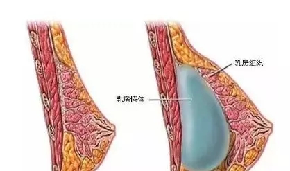 自體脂肪or假體隆胸，我到底應(yīng)該怎么選？