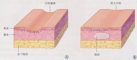 明星的臉和你的臉差的只是這一步！--面部脂肪填充