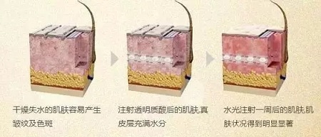 水光，打1次和4次究竟有多大區(qū)別？