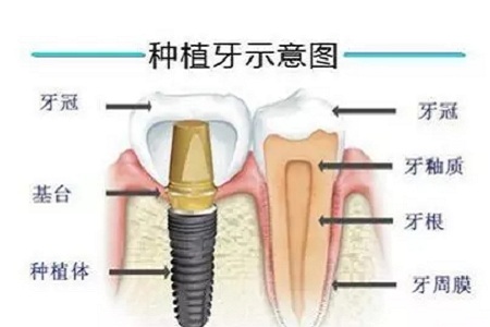 揭秘牙齒矯正的全過程?。?！