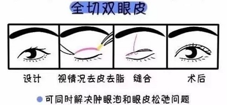 美眼張誠坐診美萊，淺談為什么你的眼睛不夠美？