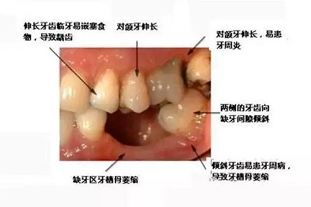 牙齒缺失時，選烤瓷牙還是那種？