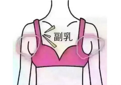 深圳副乳手術多少錢