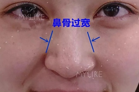 側(cè)面看鼻梁不矮,正面看鼻子卻很塌是什么原因？