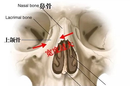 側(cè)面看鼻梁不矮,正面看鼻子卻很塌是什么原因？