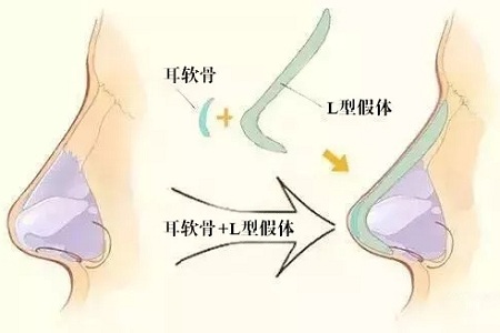 為什么鼻尖不建議用假體