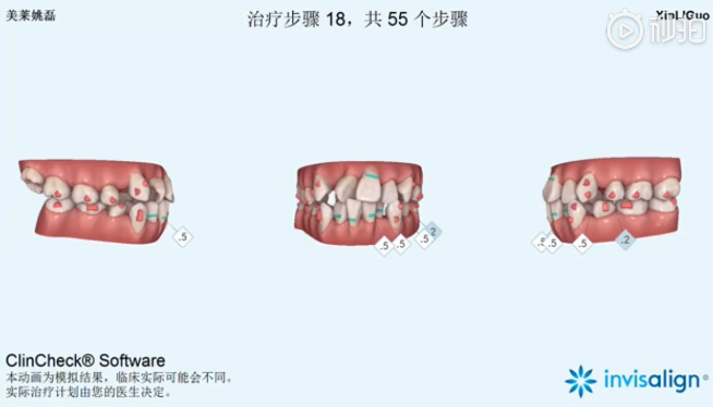 南京美萊口腔全景側(cè)位片，拍照取模，動畫方案設(shè)計