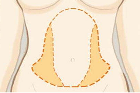 腰腹吸脂瘦身注意事項(xiàng)有哪些