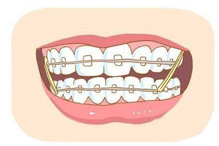 牙齒矯正術(shù)后注意什么
