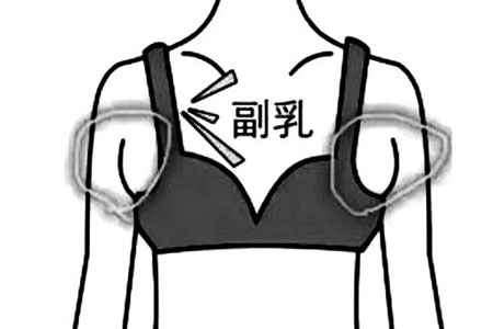 副乳切除術(shù)后需要住院嗎