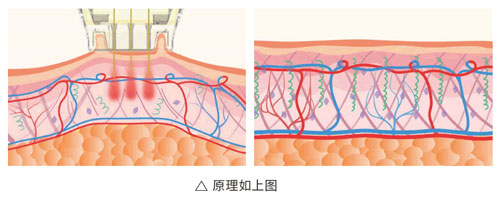 超光子+水光，“撐起”皮膚彈、潤(rùn)、緊